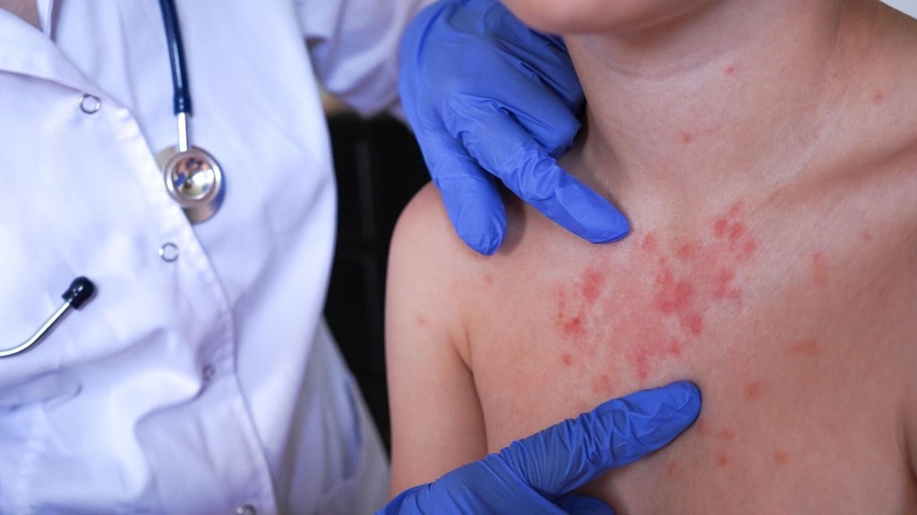 Minnesota's 80 measles cases this year are the most since 1990, health officials say — Richfield Health news