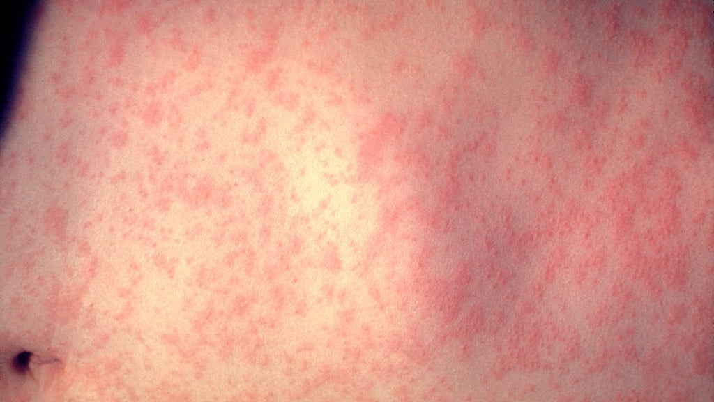 25 cases of measles identified in central, southeastern Minnesota, MDH says — WCCO / CBS Minnesota, Richfield Health news